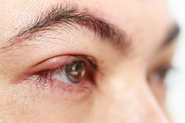 eye stye