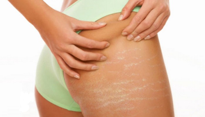 8 Remedies To Get Rid Stretch Marks